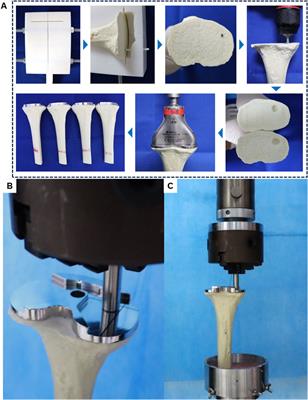 Biomechanical analysis of different techniques for residual bone defect from tibial plateau bone cyst in total knee arthroplasty